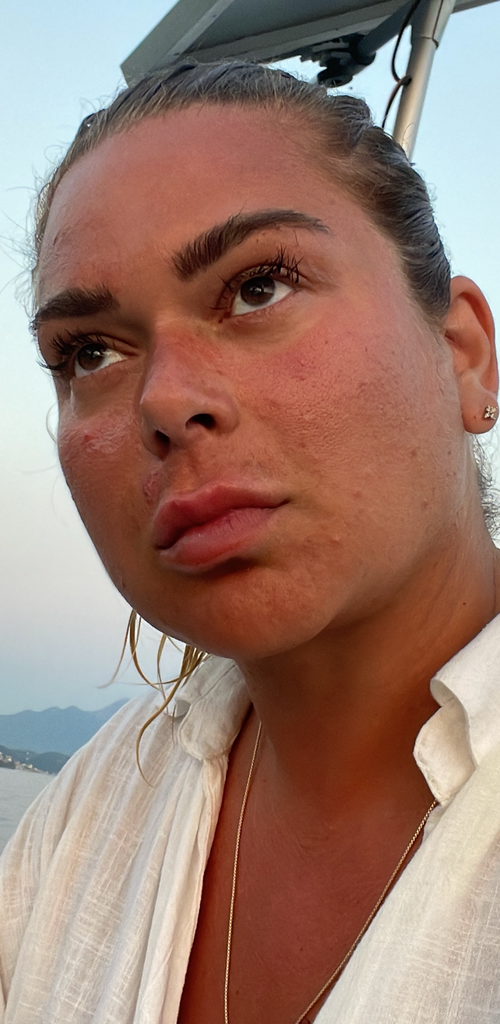 Jelenas berättelse om stressad, reaktiv hud