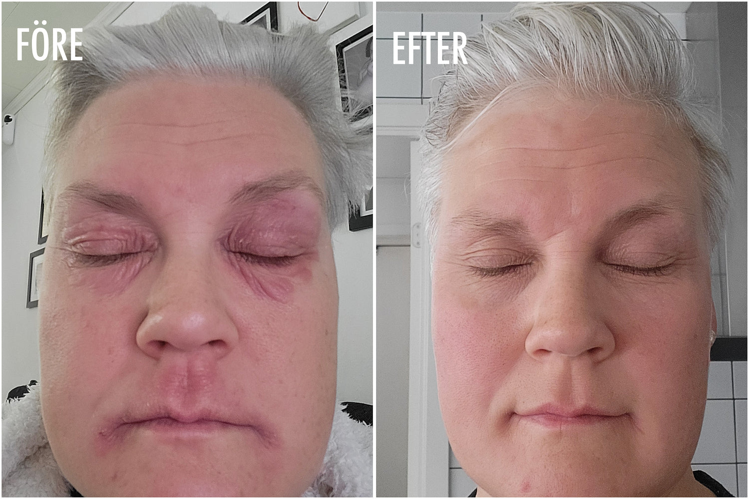 "Min IBS-mage var katastrof, och det syntes direkt på huden" - Linda