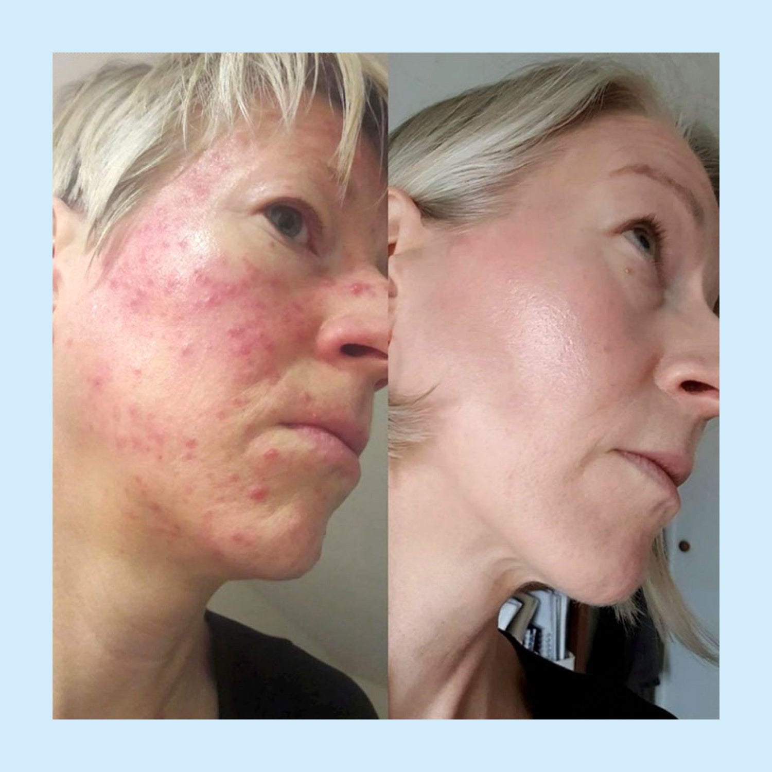 Så minskade Nikkis rodnad och plitor i ansiktet