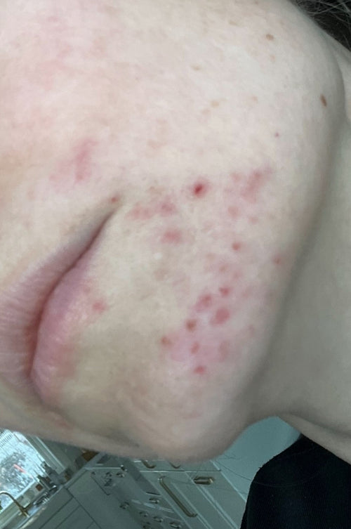 Tess berättelse om perioral dermatit-benägen hud