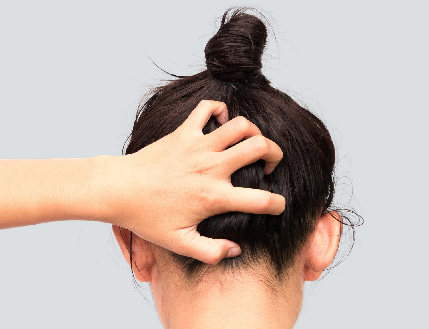 Våra kunder berättar om sina hårbottenbesvär