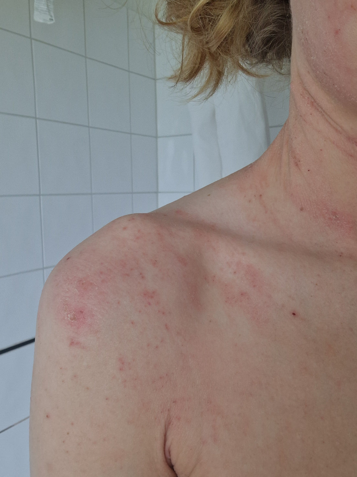 Vad kan orsaka torr, känslig hud?