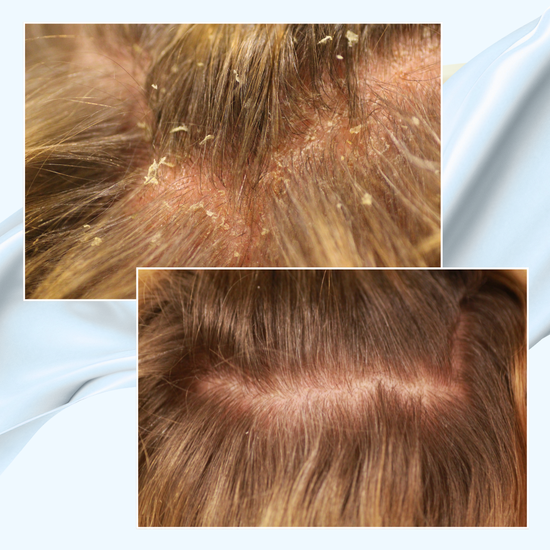 Startpaket - hårbottenbesvär