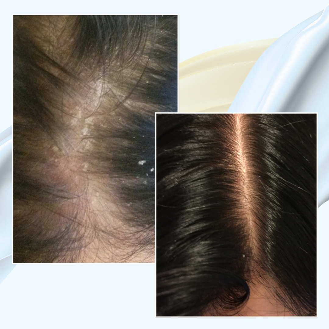 Startpaket - hårbottenbesvär